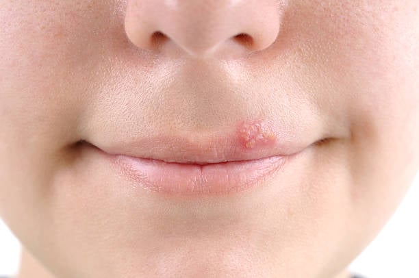 Herpes Labial